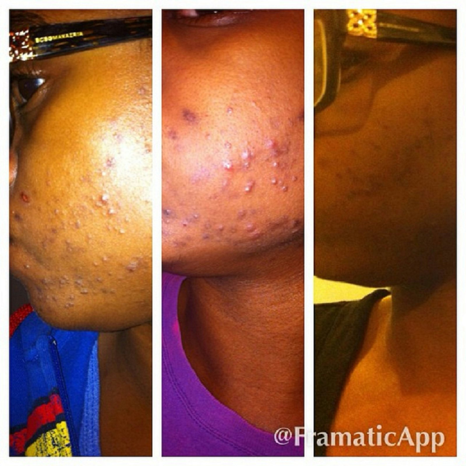 Stress Hormones and Your Skin: The Hidden Link You Need to Know